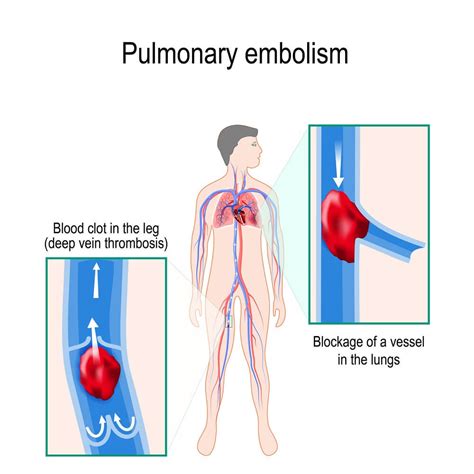 embolism definition